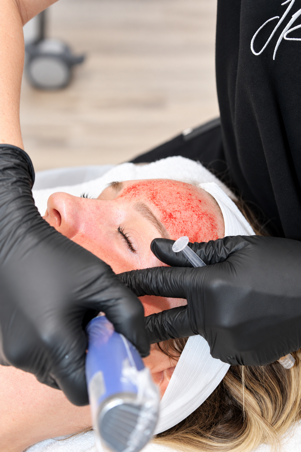 Microneedling